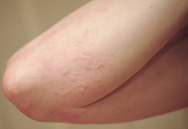 Bột lá húng chanh có thể dùng trong các bệnh về da