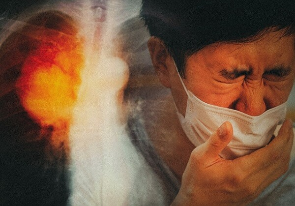 Triệu chứng viêm phổi không điển hình ở người lớn