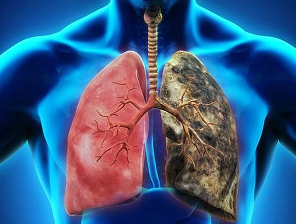 Triệu chứng giai đoạn cuối của lao phổi