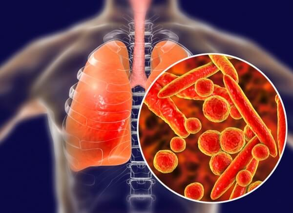 Vi khuẩn lao chủ yếu phát triển tại phổi