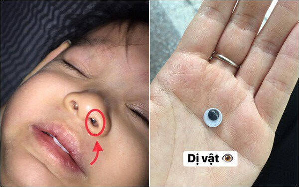 Trẻ bị nghẹt mũi do mắc dị vật trong mũi